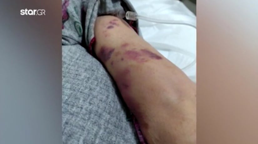 Αποκλειστική νοσοκόμα σακάτεψε στο ξύλο την ηλικιωμένη που φρόντιζε στο Τζάνειο Νοσοκομείο 9 095C9A58 4EB1 4224 BBA2 4795A610E0B3