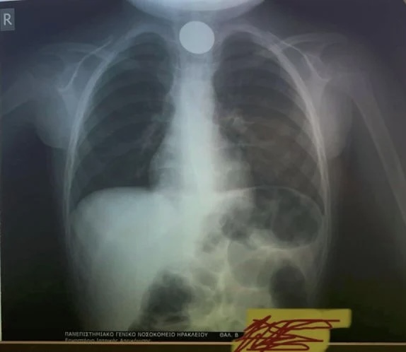 Τετράχρονο αγοράκι κατάπιε κέρμα - Σώθηκε απο θαύμα των γιατρών 6 IMG 9935