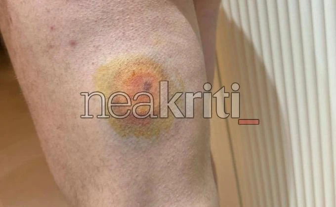 Κρήτη: Πάνω από δέκα αγρότες και κτηνοτρόφοι τραυματίστηκαν από πλαστικές σφαίρες που φέρεται να εκτόξευσαν οι αστυνομικές δυνάμεις 9 IMG 9942