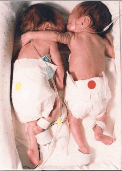 Το Αγκαλιάσμα που Έσωσε μια Ζωή: Η Αληθινή Ιστορία των Δίδυμων που Άλλαξαν την Ιατρική 7 IMG 3903